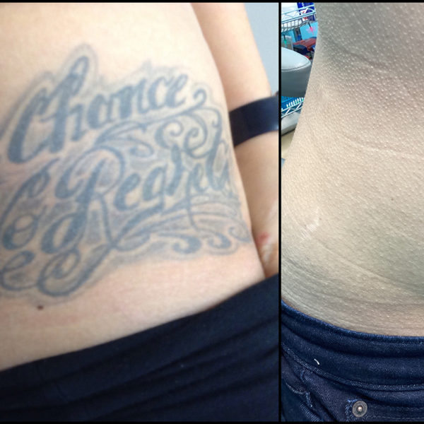 Before And After Photos InkAway Laser Tattoo Removal