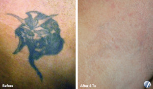 laser tattoo removal media, pennsylvania