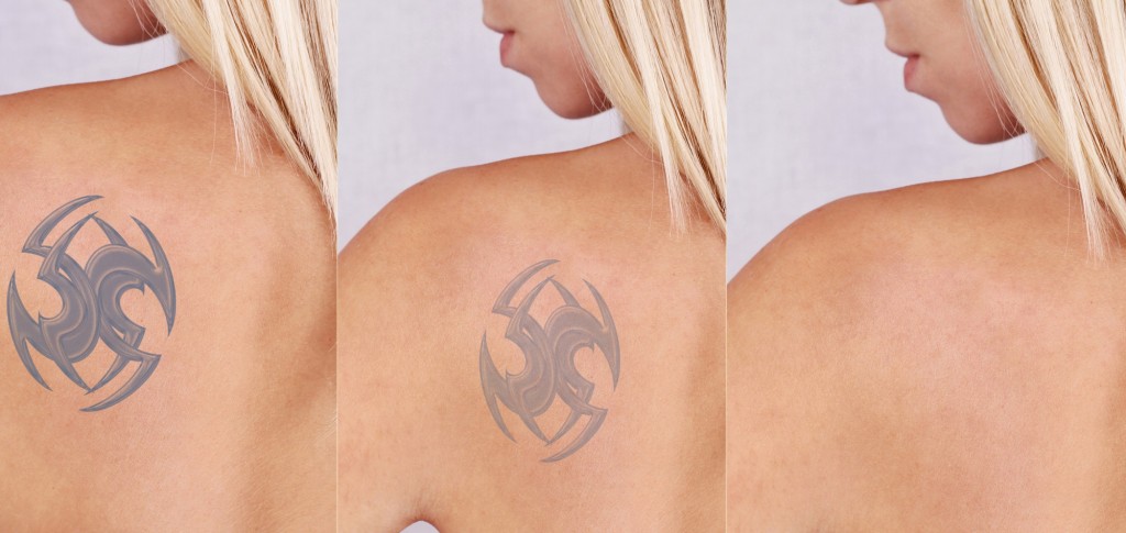 Blog - Latest Posts - Page 10 of 11 - InkAway Laser Tattoo Removal