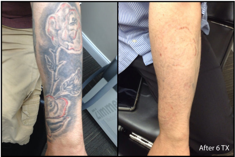 Tattoo Removal Philadelphia Neck beforeafter March