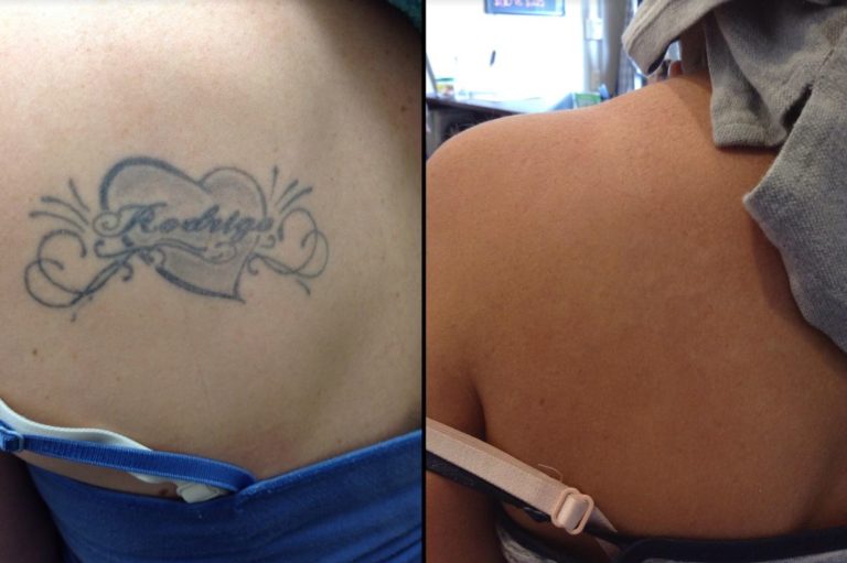 Before after tattoo removal April 20214 InkAway Laser
