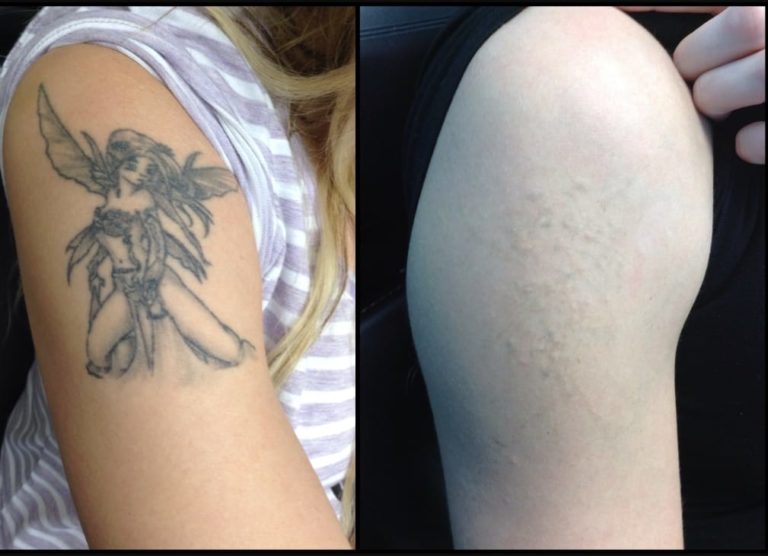 5. Laser Tattoo Removal Specialists in Philadelphia - wide 4