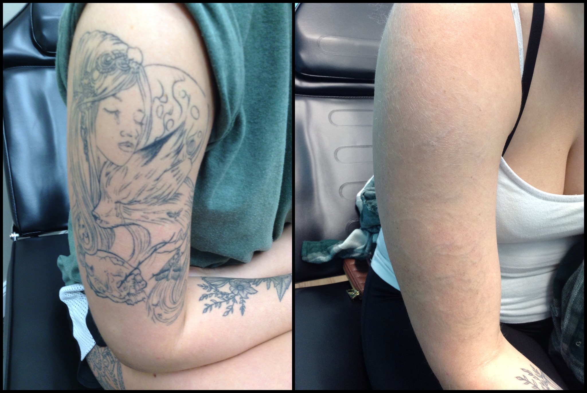 Tattoo Removal Philadelphia arm -before-after - October 2020 - 1 - InkAway Laser  Tattoo Removal