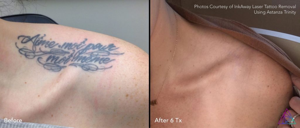 Best Before After Tattoo Removal Photo
