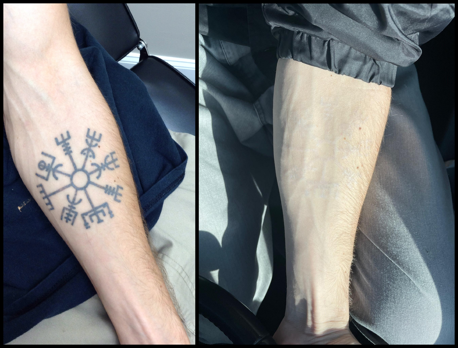 Philadelphia Laser Tattoo Removal - InkAway Laser Tattoo Removal