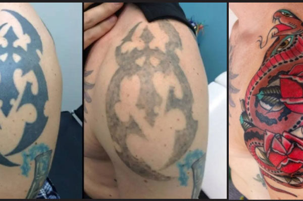 National Award Winning Tattoo Removal Coverup