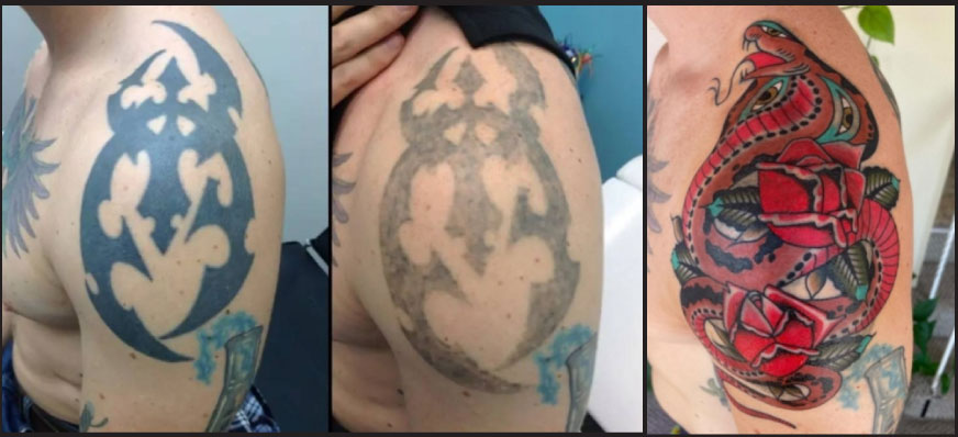 How Tattoos Are Removed.Everything You Need To Know About Laser Tattoo Removal