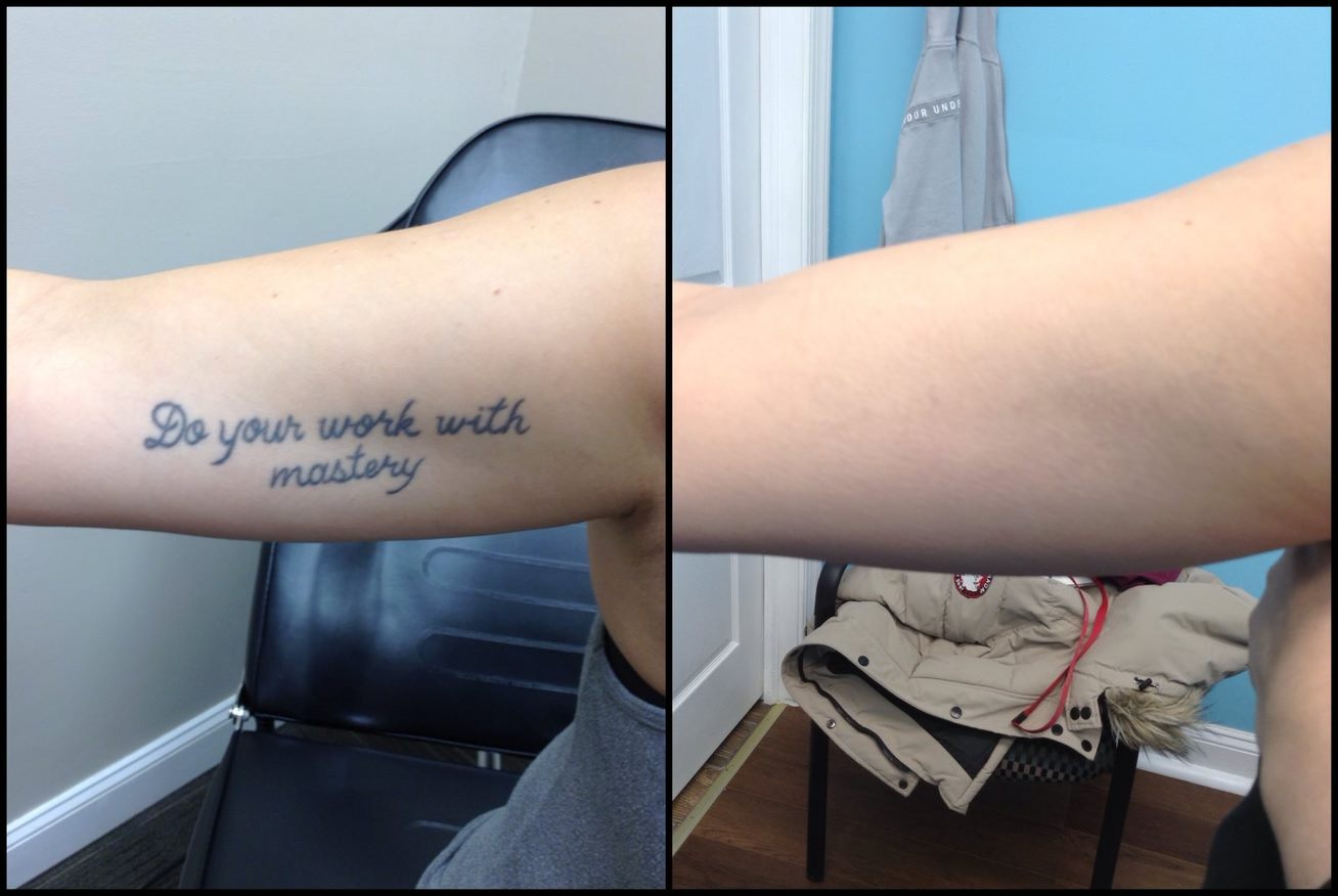 Before after tatttoo on Arm - Feb 2022 - InkAway Laser Tattoo Removal
