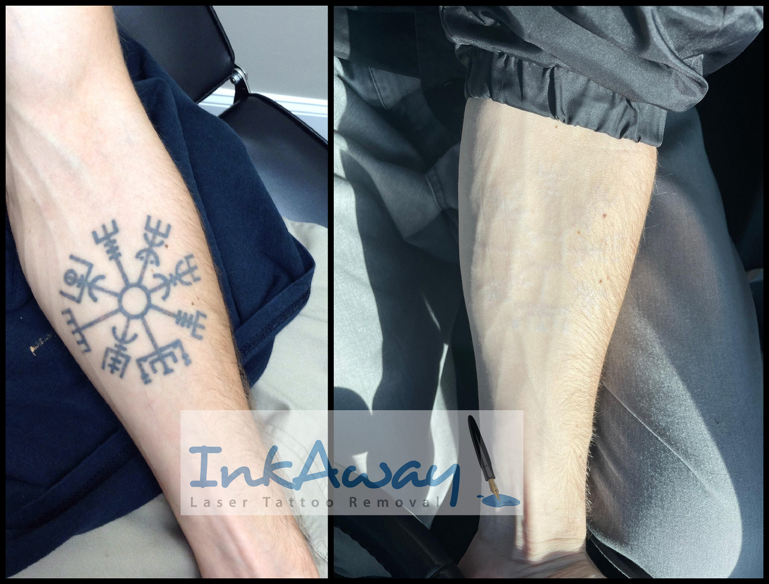 Philadelphia Laser Tattoo Removal - InkAway Laser Tattoo Removal