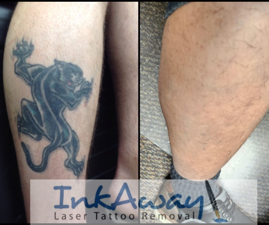 Best Tattoo Removal Before After of 2023 - InkAway Laser Tattoo Removal