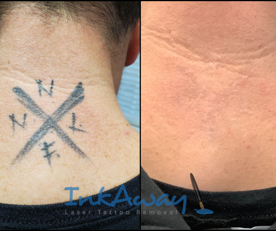 Before and After Photos - InkAway Laser Tattoo Removal