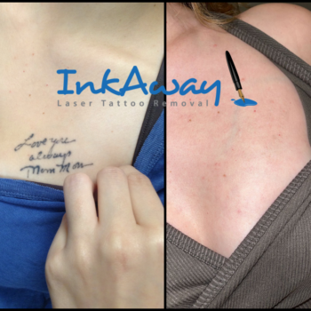 Tattoo Removal - Chest Area