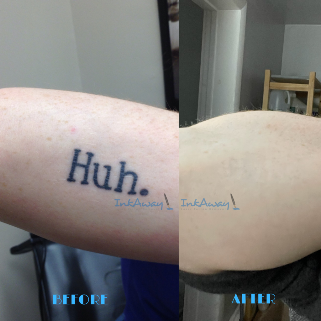 Does Tattoo Removal Cream Work? What Dermatologists Recommend 2023